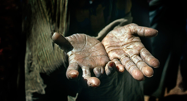 Je lepra zpět? Jak poznat příznaky? Co znamenají nové případy v Rumunsku a Chorvatsku?